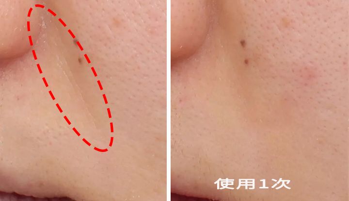 消除眉间法令纹最有效的方法,眉间纹和法令纹医美