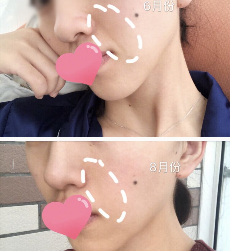 消除眉间法令纹最有效的方法,眉间纹和法令纹医美