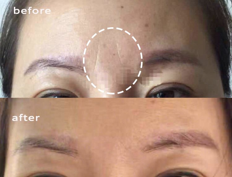 35岁了法令纹鱼尾纹眉间纹怎么办,三十岁就有眉间纹法令纹怎么办