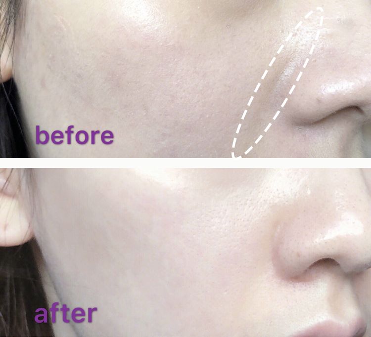 消除眉间法令纹最有效的方法,眉间纹和法令纹医美