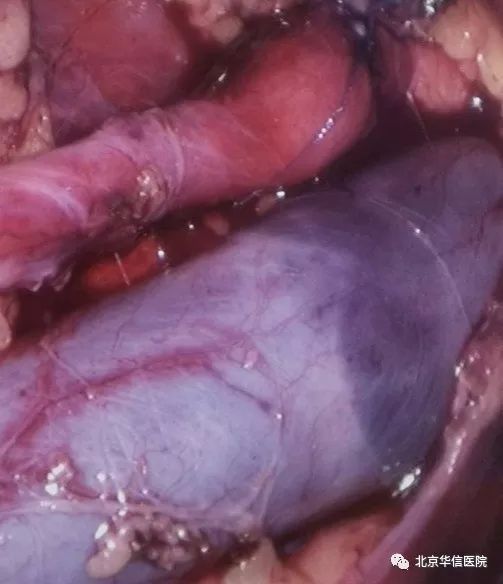 微创技术显神威！泌尿外科成功为先心术后患儿实施腹腔镜右输尿管复位矫形术