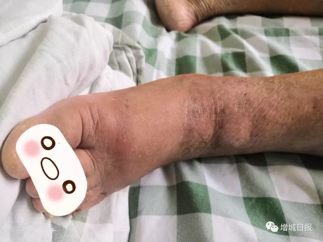 被红火蚁咬伤新闻,被一只红火蚁咬伤后的处理