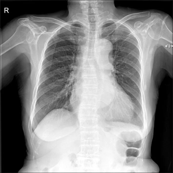 胸疼还有一个坑,胸痛症状缓解可能是陷阱