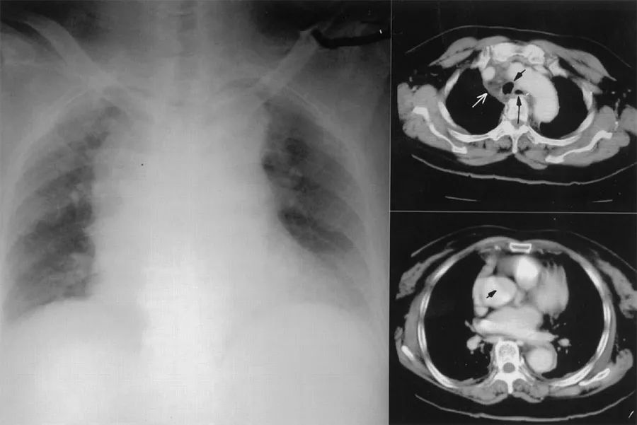 胸疼还有一个坑,胸痛症状缓解可能是陷阱