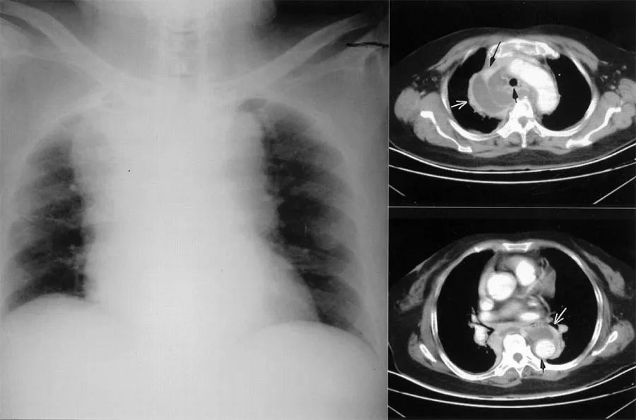 胸疼还有一个坑,胸痛症状缓解可能是陷阱