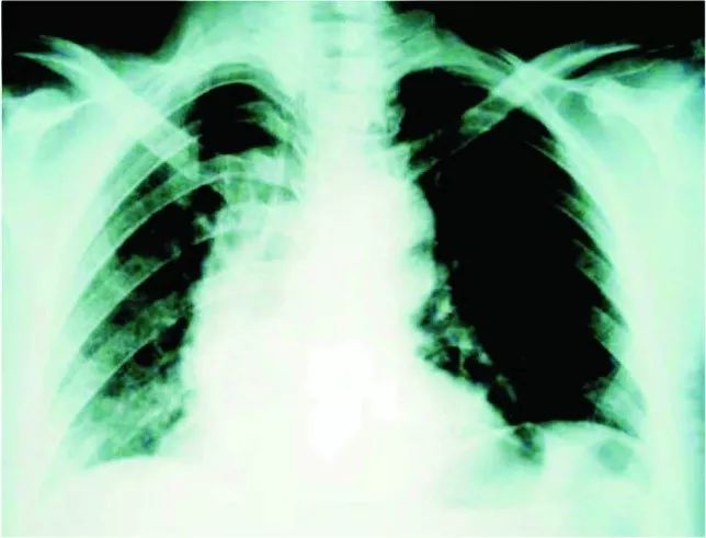 胸疼还有一个坑,胸痛症状缓解可能是陷阱