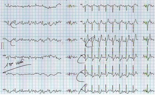 胸疼还有一个坑,胸痛症状缓解可能是陷阱