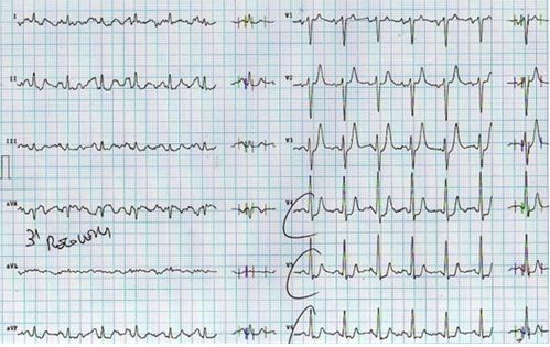 胸疼还有一个坑,胸痛症状缓解可能是陷阱