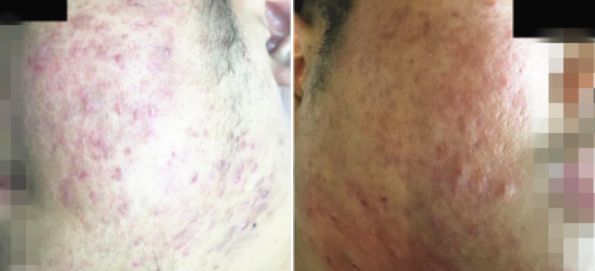 玉颜阁能祛痘痘吗,玉颜阁治什么病最好