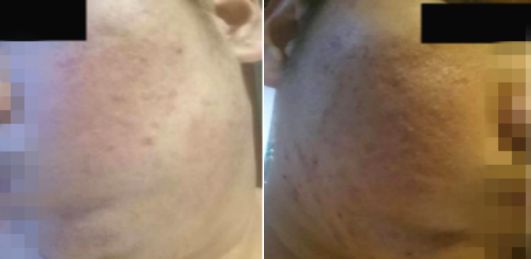 玉颜阁能祛痘痘吗,玉颜阁治什么病最好