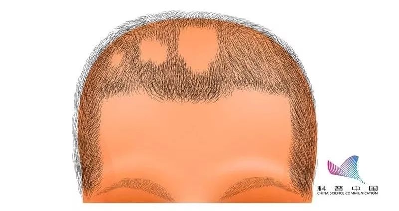 鬼剃头为什么没有掉下来的头发,鬼剃头了头发还能长出来吗