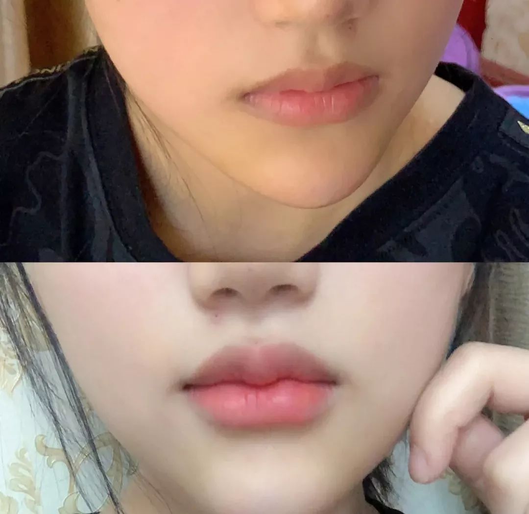 丰唇怎样让唇边更立体,适合丰唇的唇形