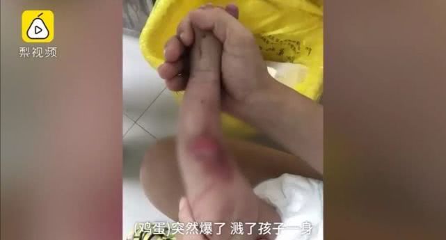 心疼!菏泽一月嫂抱仅40天男婴做饭时锅中鸡蛋突然爆开,孩子腿和肚皮烫出了泡...