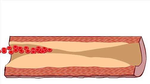 血脂异常是无声的杀手,血脂异常医生健康科普