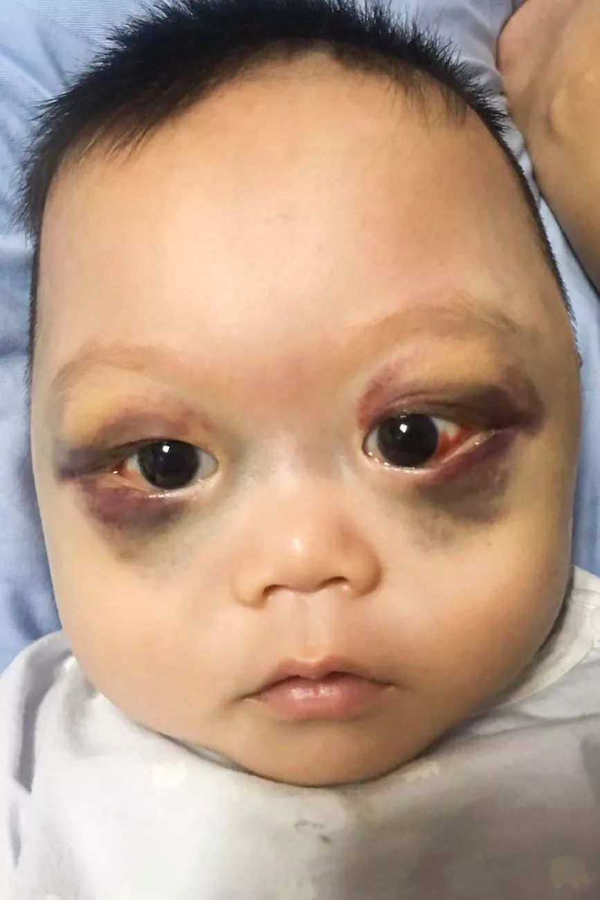 小男孩双眼淤青肿胀，酷似熊猫眼，父母曾被人怀疑虐待孩子