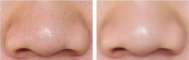 鼻头痘痘爆浆,鼻头痘痘挤出来的白色物质是什么