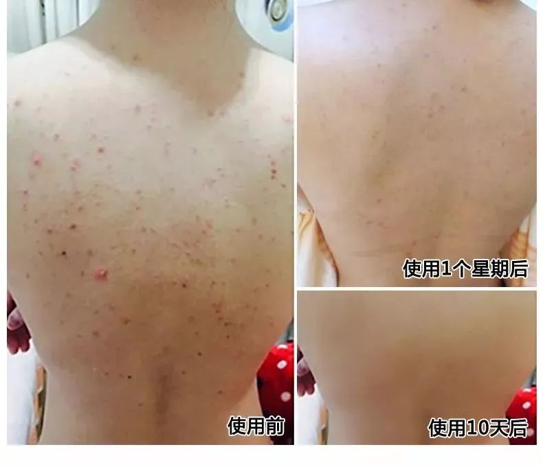 鼻头痘痘爆浆,鼻头痘痘挤出来的白色物质是什么