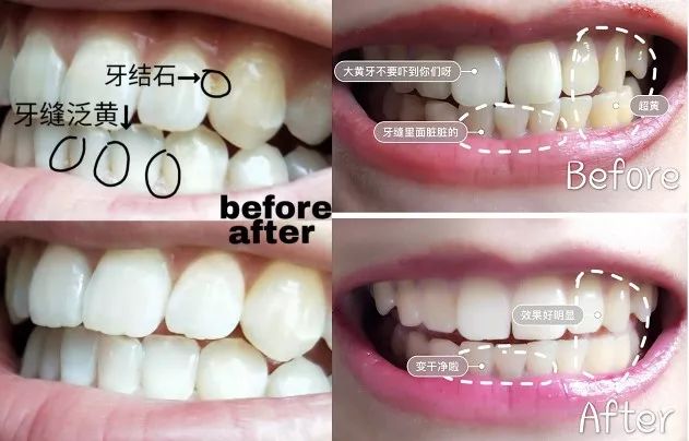 牙龈肿了出血口臭牙黄用什么牙膏,牙龈上火牙膏