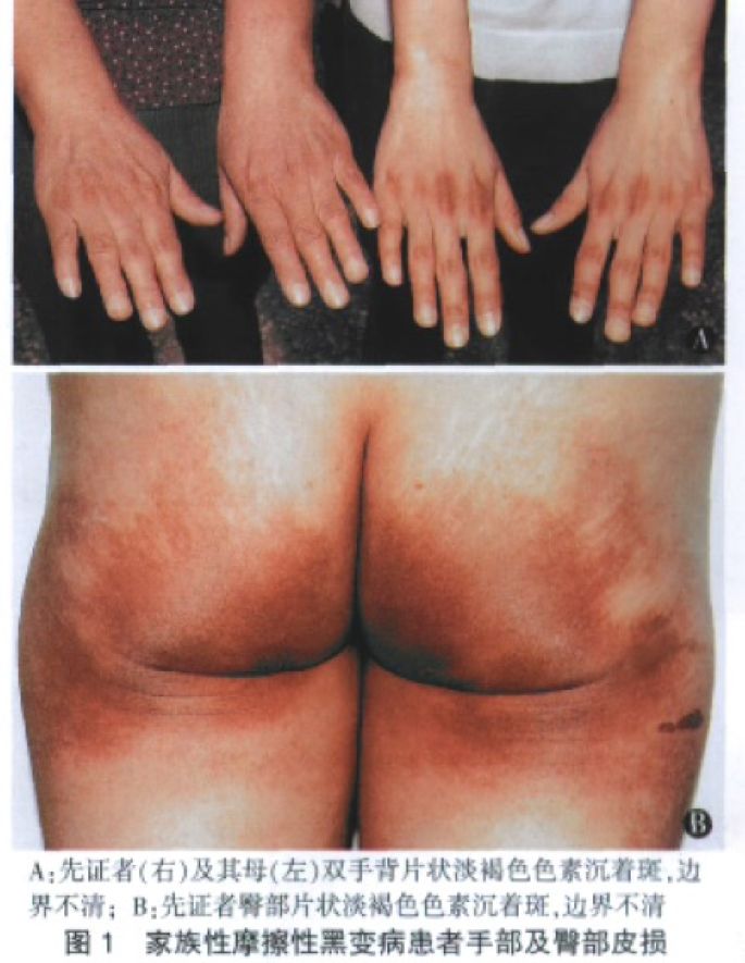 用力搓澡会让皮肤越搓越黑,身体黑搓澡可以搓白吗