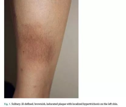 用力搓澡会让皮肤越搓越黑,身体黑搓澡可以搓白吗