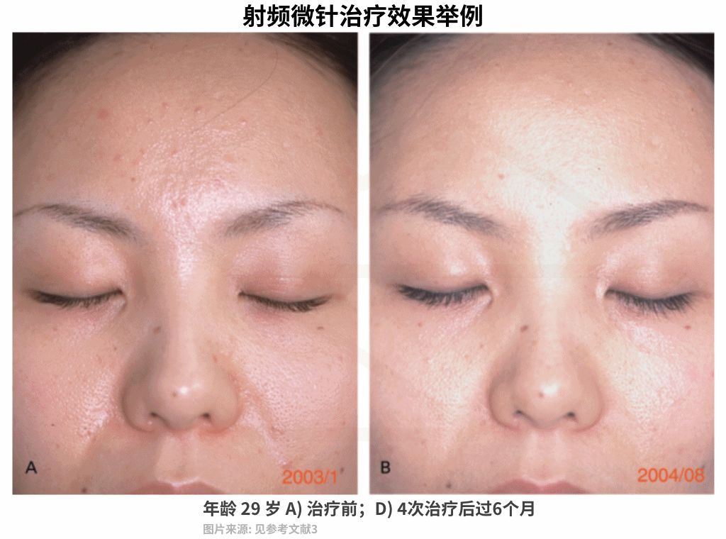 十几年的痘坑毛孔粗大,毛孔粗大不可逆别慌还有救