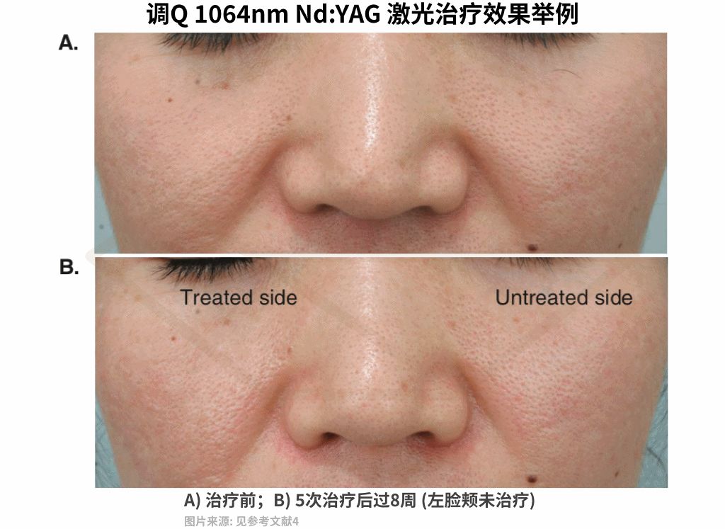 十几年的痘坑毛孔粗大,毛孔粗大不可逆别慌还有救