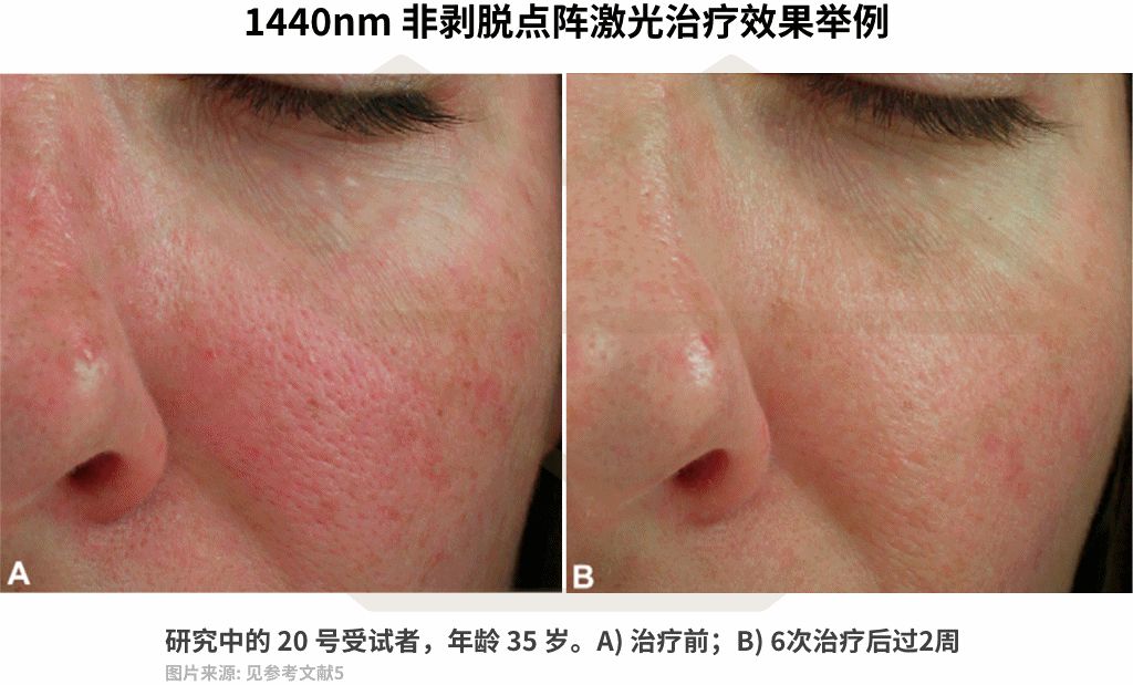 十几年的痘坑毛孔粗大,毛孔粗大不可逆别慌还有救