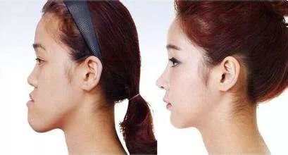 关于医美的真相大全,两年医美的真实感受