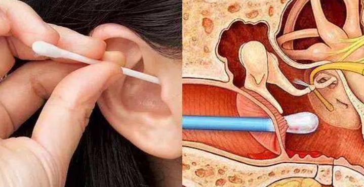 耳道小知识,关于耳屎你必须知道的几件事