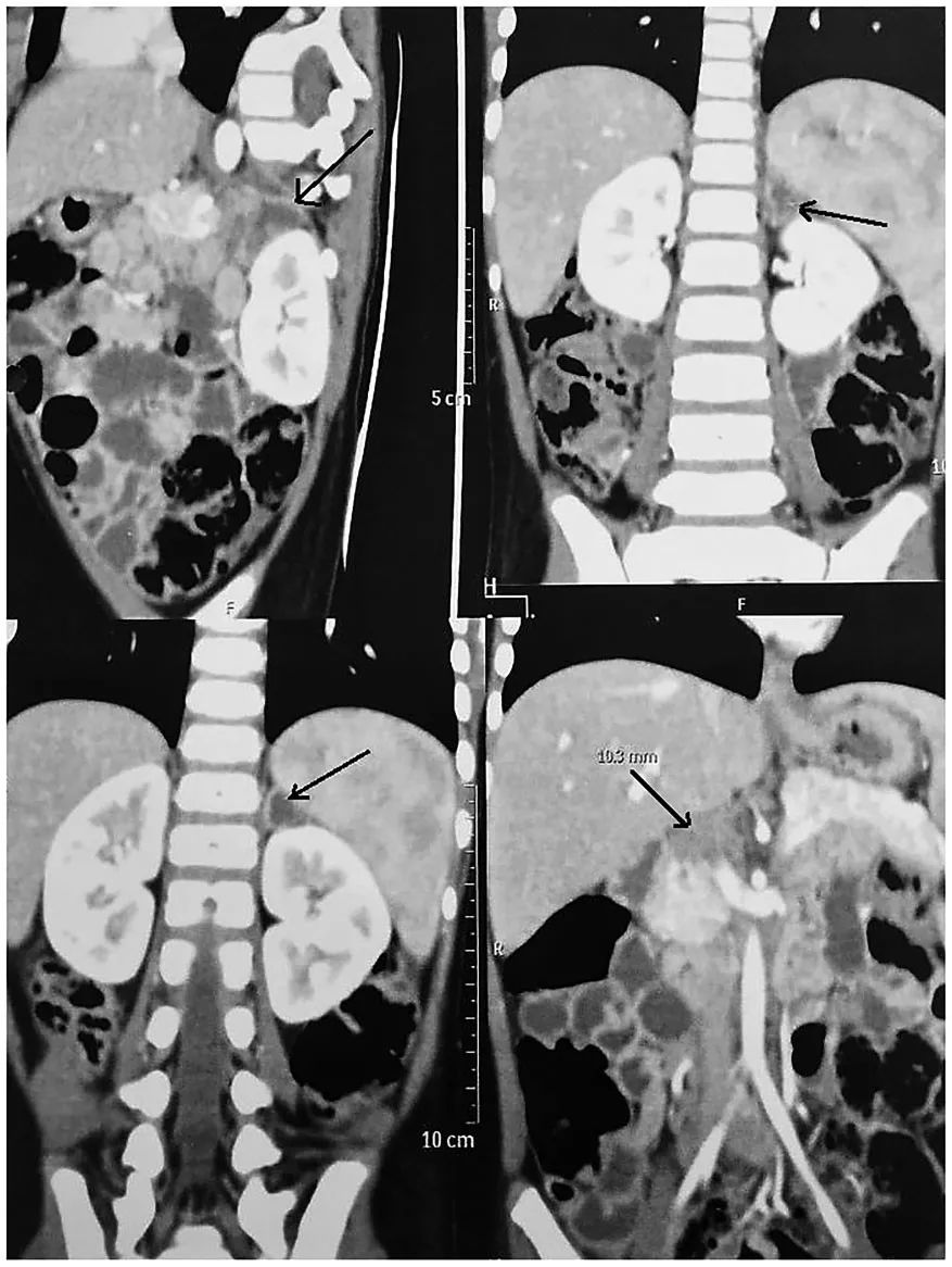 低血糖休克和过敏休克,低血糖高钾血症酸中毒怎么处理