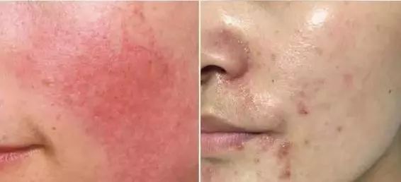 拒绝“螨虫脸”！5秒揉一揉，螨虫全出来了，痘痘黑头全没了