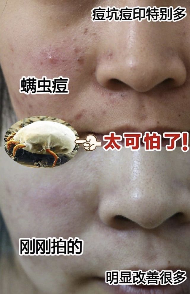 拒绝“螨虫脸”！5秒揉一揉，螨虫全出来了，痘痘黑头全没了