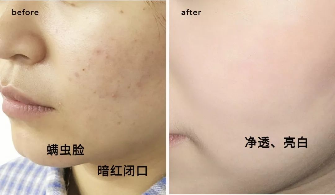 拒绝“螨虫脸”！5秒揉一揉，螨虫全出来了，痘痘黑头全没了