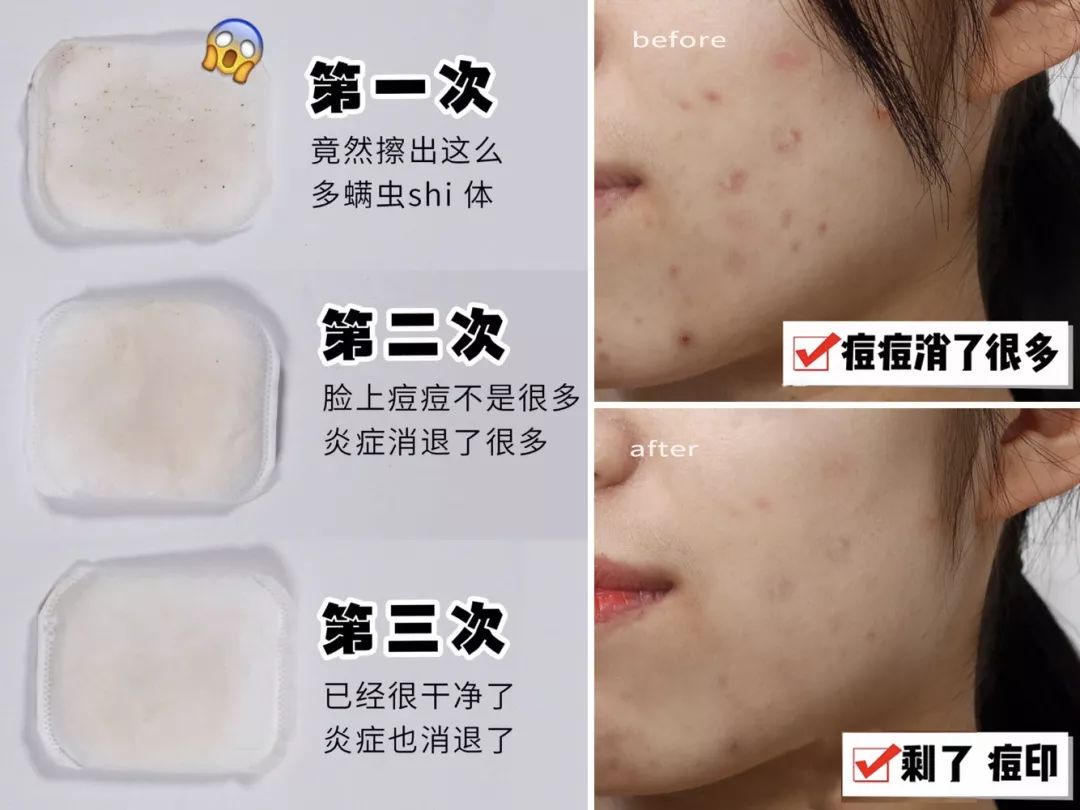 拒绝“螨虫脸”！5秒揉一揉，螨虫全出来了，痘痘黑头全没了