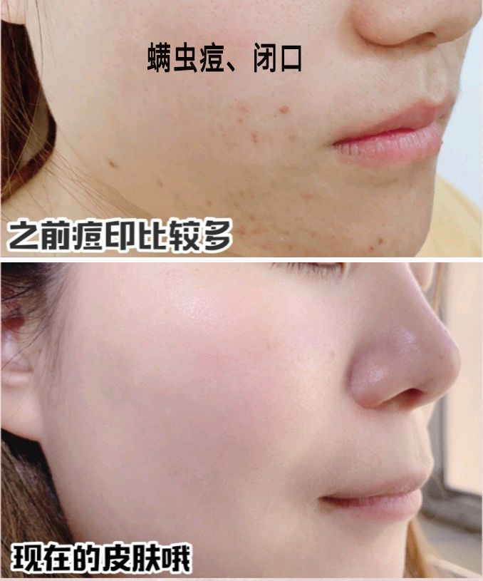 拒绝“螨虫脸”！5秒揉一揉，螨虫全出来了，痘痘黑头全没了