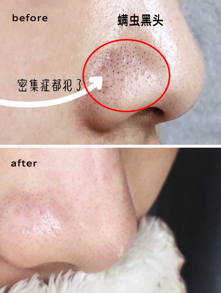 拒绝“螨虫脸”！5秒揉一揉，螨虫全出来了，痘痘黑头全没了