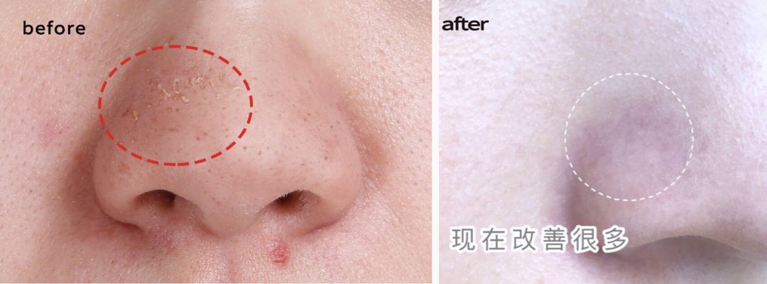 拒绝“螨虫脸”！5秒揉一揉，螨虫全出来了，痘痘黑头全没了