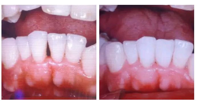 特别爱长牙石是怎么回事,长牙石是什么原因引起的