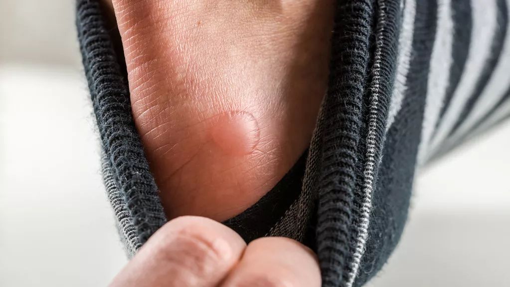 脚上磨的泡是挑破还是不挑破,脚上磨起了泡要不要挑破