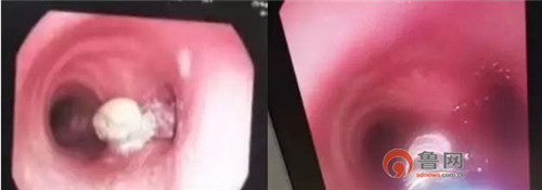 即墨一患者肿瘤堵住支气管“冷冻”技术救了她