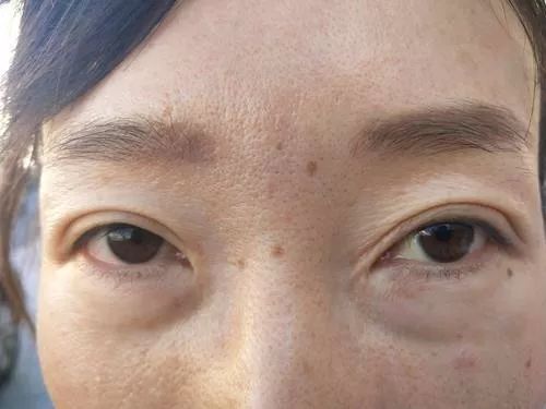 女子整容失败后欲哭无泪,女子整容整到脸上神经错乱