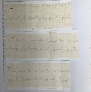 肺癌介入栓塞术后并发症,肺癌术后肺栓塞的病历模板