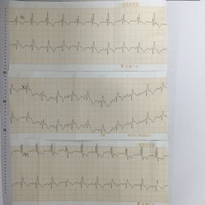 肺癌介入栓塞术后并发症,肺癌术后肺栓塞的病历模板