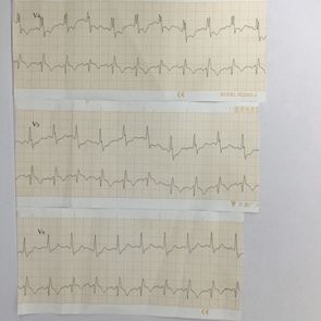肺癌介入栓塞术后并发症,肺癌术后肺栓塞的病历模板