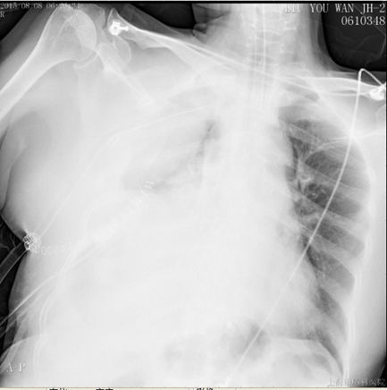 肺癌介入栓塞术后并发症,肺癌术后肺栓塞的病历模板