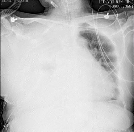 肺癌介入栓塞术后并发症,肺癌术后肺栓塞的病历模板