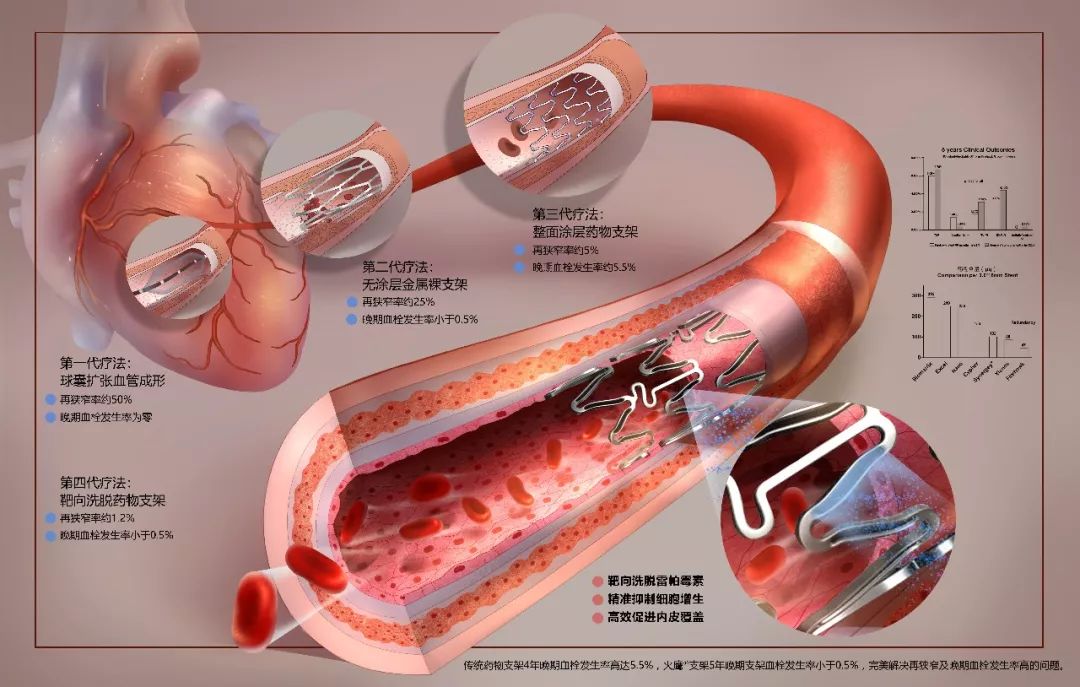 心脏支架美国最新试验,美国最新心脏支架