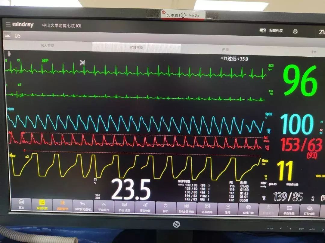 icu病房怎么监护,icu床边ct有影响吗
