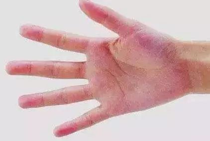 痣是肝癌的早期信号吗,肝癌身上出现红痣图片提示