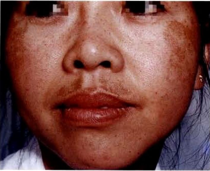 氨甲环酸对哪些斑有效,氨甲环酸祛褐青斑吗